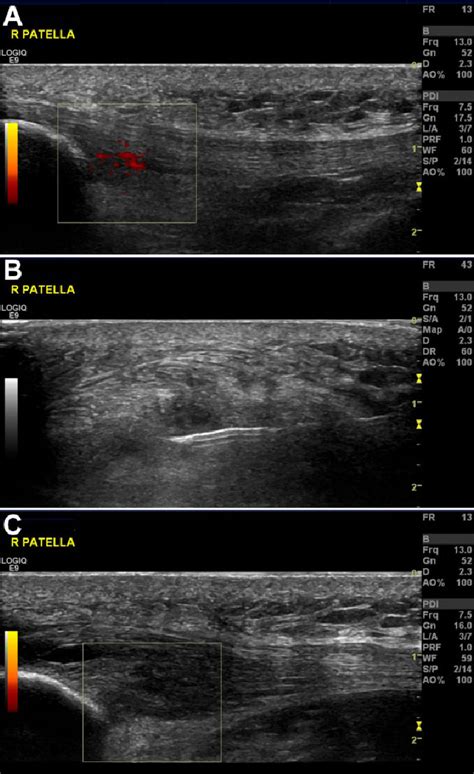 Figure 1 From High Volume Image Guided Injections In Achilles And