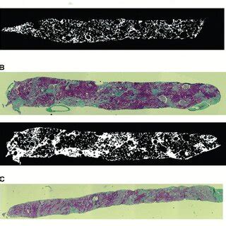 Biopsies Of Interstitial Fibrosis IF Each Showing A Section Of Renal