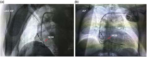 Figure 1 From Reversal Of Left Bundle Branch Block Induced Cardiomyopathy By His Bundle Pacing