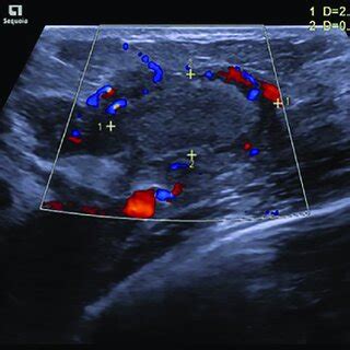 Ultrasound Of The Left Breast Revealing A Speculated Rounded Lesion