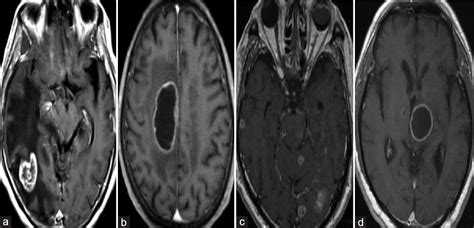 Assessment Of Intracranial Metastases From Neuroendocrine Tumors