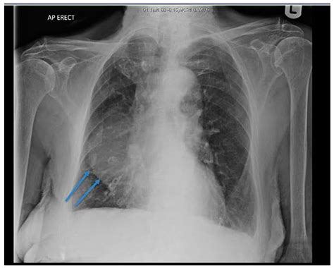 Image Diagnosis: Pericardial Cyst The Permanente Journal, 55% OFF