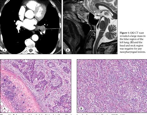 Figure From Primary Lymphoepithelioma Like Carcinoma Of The Lung