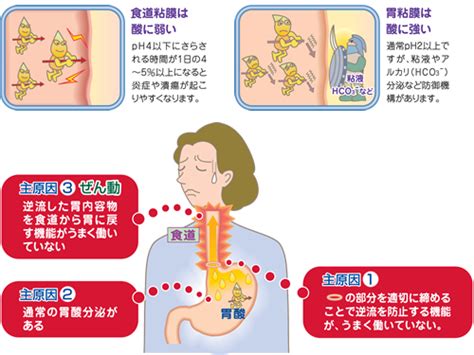 逆流性食道炎・非びらん性胃食道逆流症 患者さん・ご家族の皆さま 田辺三菱製薬株式会社