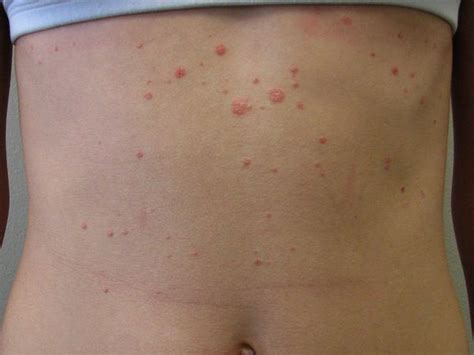 Psoriasis Overview And More