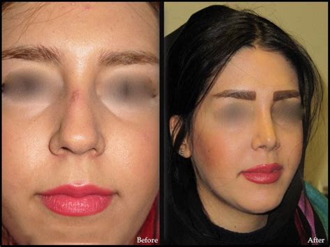 Women Rhinoplasty Gallery Nose Surgery Before After Photos Samamedtour