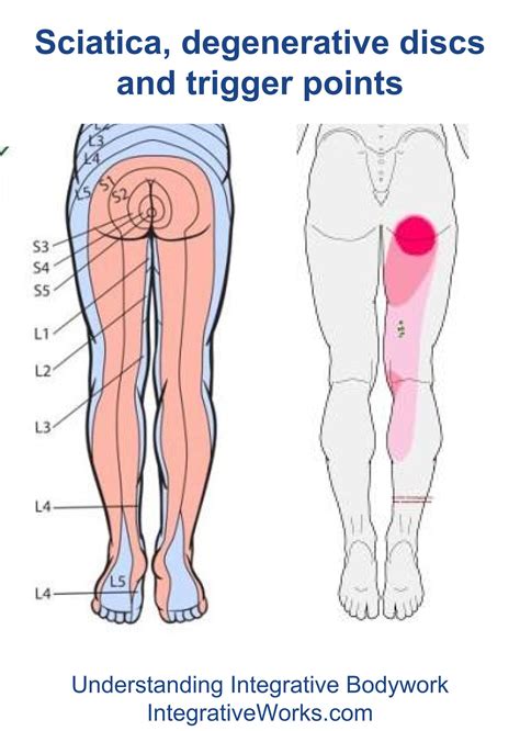 Sciatica Degenerative Discs And Trigger Points Integrative Works