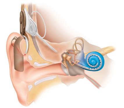 Lippy Surgery Center – Warren, OH » Implants for Hearing Loss and Deafness