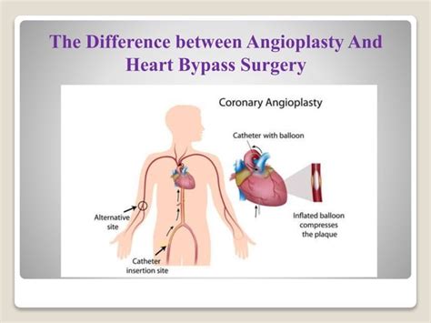 Dr Gautam Angioplasty Ppt