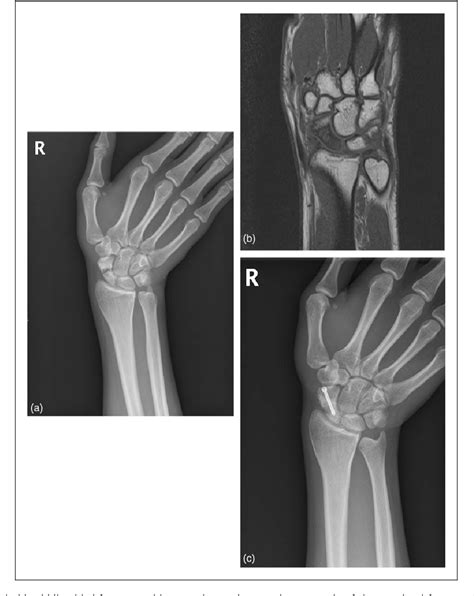 Figure 4 From Non Vascularized Iliac Bone Grafting For Scaphoid