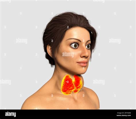 Thyrotoxic Goitre Goitre Illustration Goitre Swollen Neck Seen On