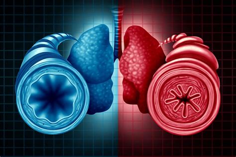 A Connection Between Sex And Asthma Respiratory Therapy