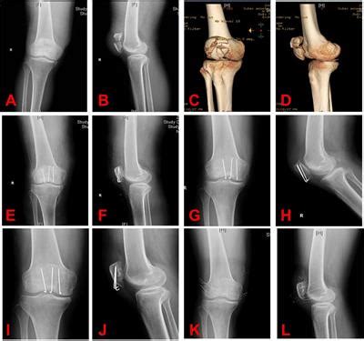 Frontiers Clinical Application Of Kirschner Wires Combined With