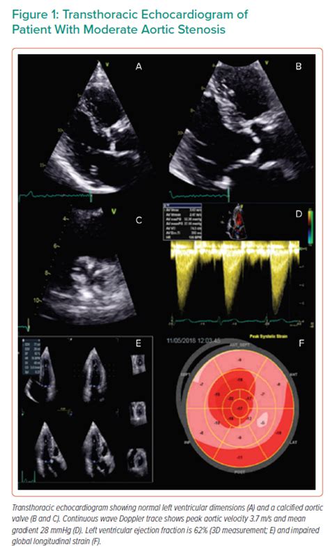 Aortic Valve Echo