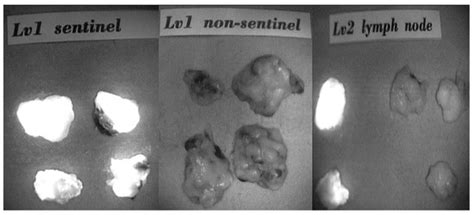 Jcm Free Full Text Is Sentinel Lymph Node Biopsy For Breast Cancer