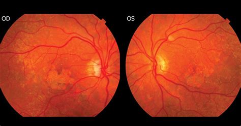 Attenuating the Rate of Progression of Geographic Atrophy Secondary to Age-Related Macular ...