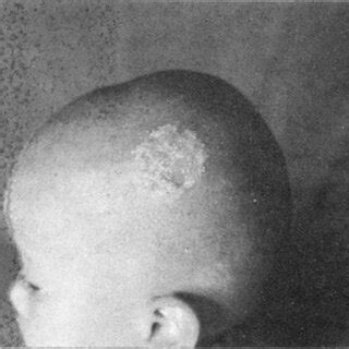 Inflammatory crusted swelling of kerion over the scalp | Download ...