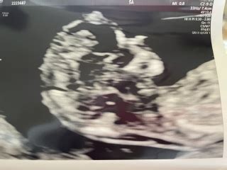 Sex Week Scan Mumsnet