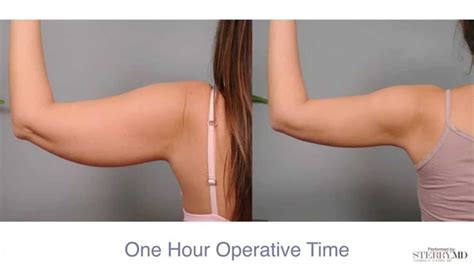 Get Firm Sculpted Arms With Smartlipo Dr Sterry Explains Youtube