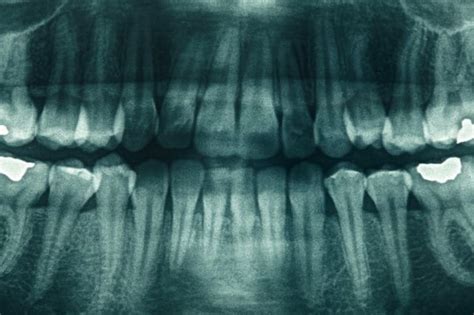 how to know if you have mercury fillings