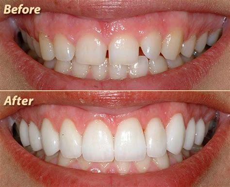 How To Fix A Chipped Tooth Cost Hilma Herrick