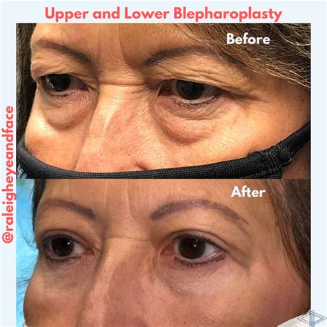 Upper Blepharoplasty Gone Wrong