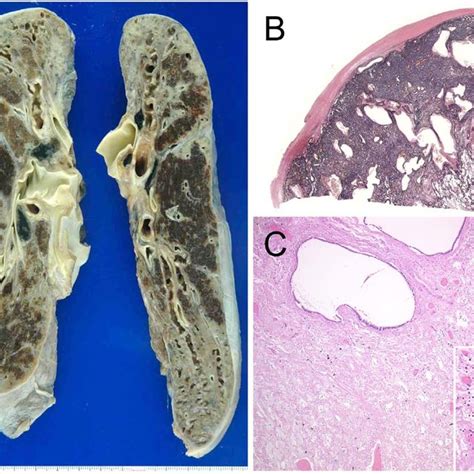 Macroscopic And Microscopic Findings Of The Lungs Obtained From Autopsy