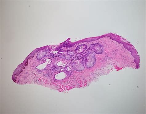 Sebecaous Adenoma Global Pathology Teaching And Education Program