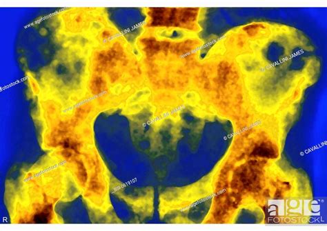 Metastasis X Ray Metastases On The Iliac Bones Due To A Prostate Cancer X Ray Of The Hips In