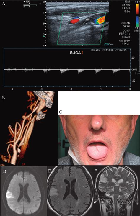 Soft Plaque Within The Right Internal Carotid Artery R Ica With A Download Scientific Diagram