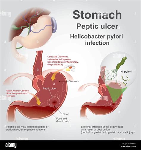 What Is Gastric Ulcer