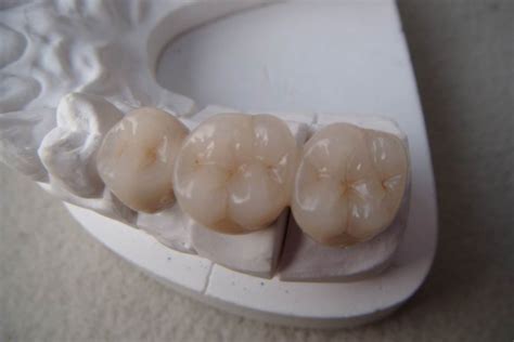 China Aesthetic Dental PFM Co Cr Crowns Bridge Manufacturers, Suppliers - Aesthetic Dental PFM ...