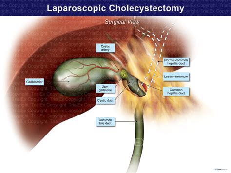 Laparoscopic Cholecystectomy Anatomy