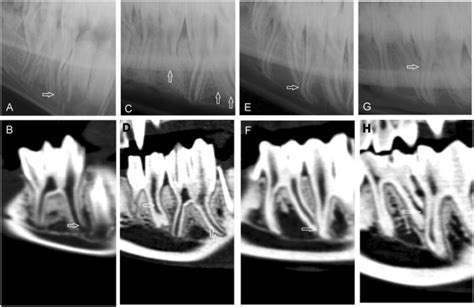 Findings In Curved Mandibular Tooth Roots At Different Ages Digital