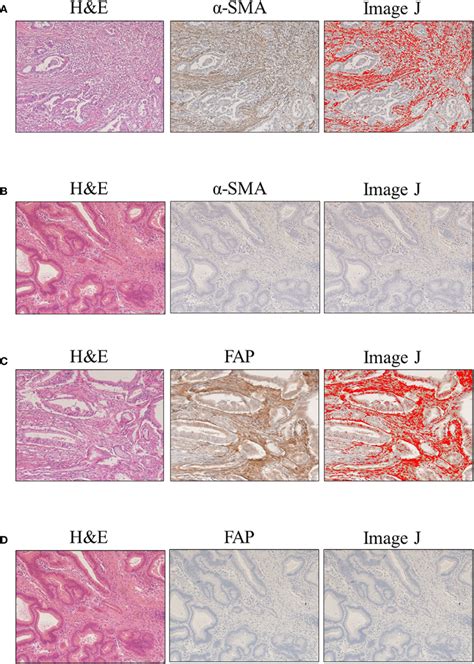 Evaluation Of Smooth Muscle Actin Sma And Fibroblast Activation