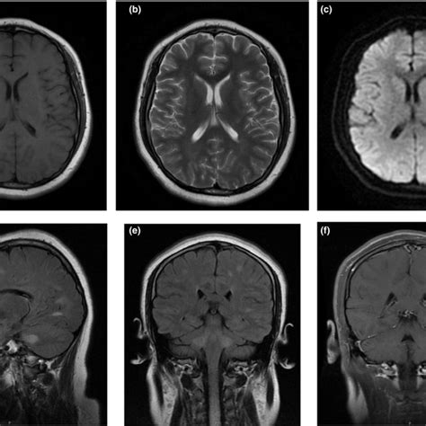 MRI‐scan 3 days after symptom onset. Brain MRI FLAIR image showing ...