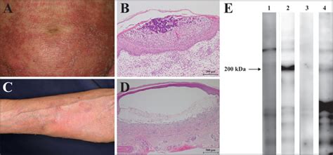 Jle European Journal Of Dermatology Anti Laminin γ1 Pemphigoid Associated With Pustular