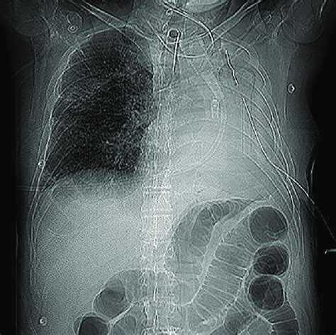 Abdominal Rx. Distended loops of bowel with visible haustra. | Download Scientific Diagram