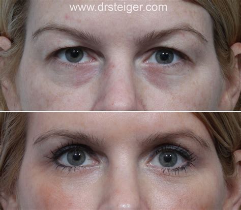 Upper Blepharoplasty Gone Wrong