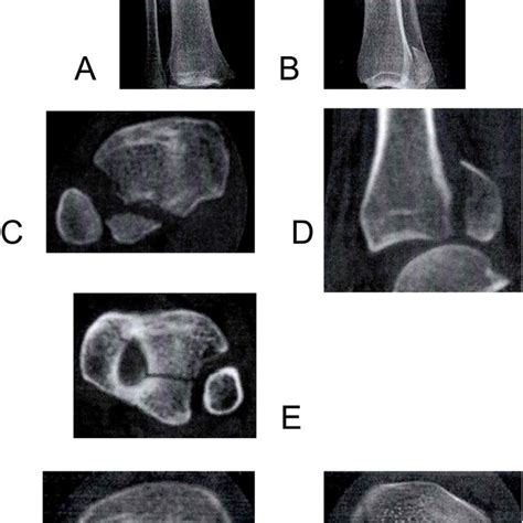 Ct Images Of Different Types Of Pilon Fracture A Type I Posterior