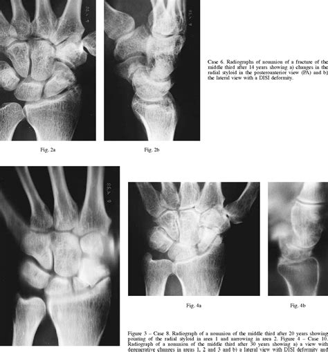 Figure 4 From The Relationship Between The Site Of Nonunion Of The