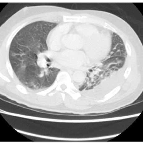 Chest Ct Shows Loculated Pleural Effusion Consolidations With Central