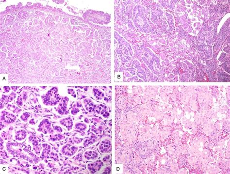 Transition From Usual Type Cervical Adenocarcinoma Top Of