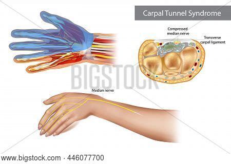 Carpal Tunnel Vector Photo Free Trial Bigstock