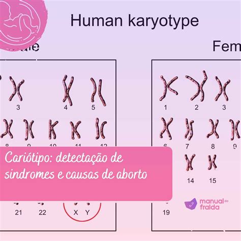 Cariótipo Detectação De Sindromes E Causas De Aborto