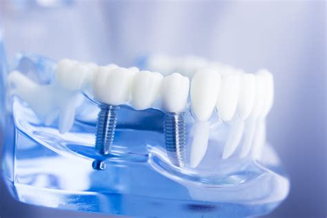 Cómo elegir los implantes dentales adecuados Clínica Dental SCJ