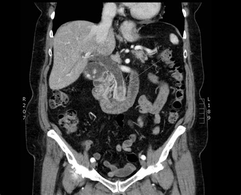 Gallstones Biliary Colic Cholecystitis Geeky Medics