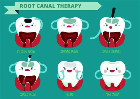 Root Canal Myths Explained | Dr. Arthur A. Kezian DDS