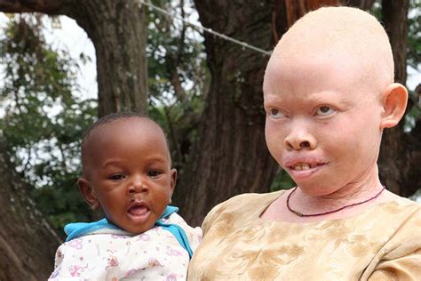 Ang Lica Italia Los Blancos Negros Documental De Rt Sobre Albinos En