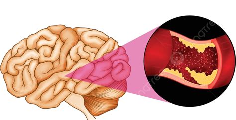 腦部圖卡通缺血 向量 圖表 卡通片 缺血性向量圖案素材免費下載，png，eps和ai素材下載 Pngtree